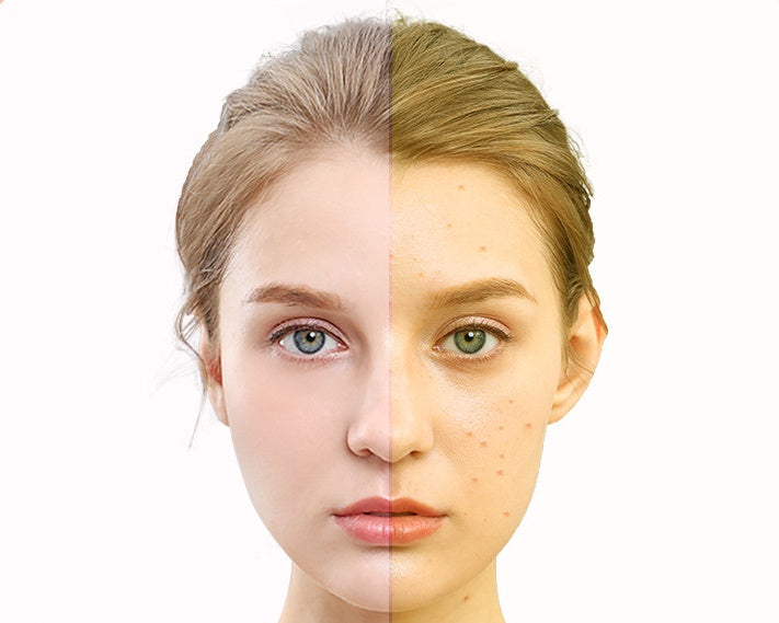 GLOZARA Photon Skin Rejuvenation LED Mask for Home IPL Therapy GLOZARA