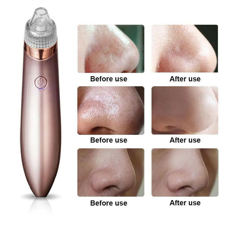 GLOZARA Electric Blackhead Remover Pore Vacuum Cleaner with Suction GLOZARA