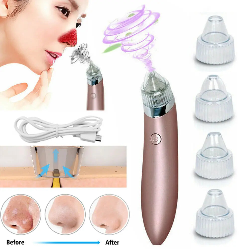 GLOZARA Electric Blackhead Remover Pore Vacuum Cleaner with Suction GLOZARA